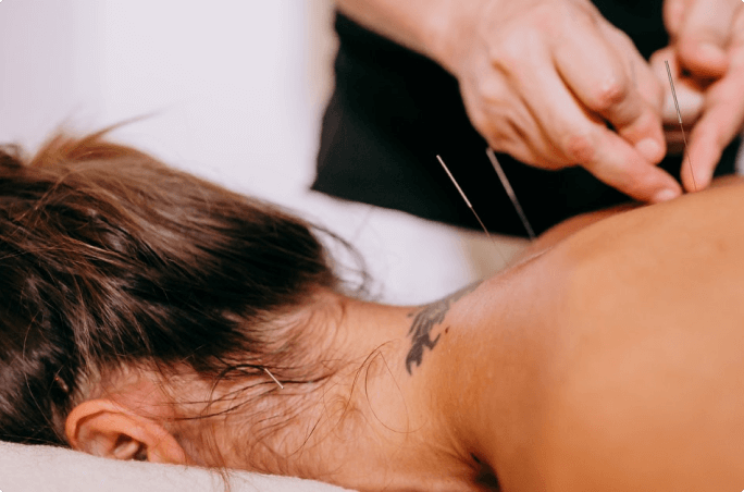 Dry Needling