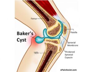 Bakers-Cyst